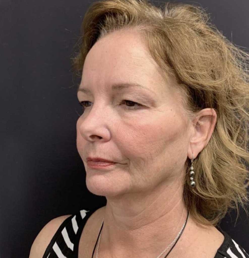 Eyelid surgery Before & After