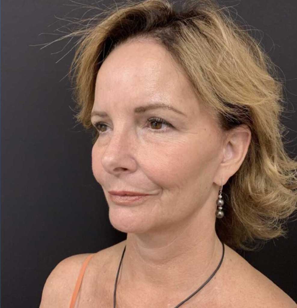 Eyelid surgery Before & After