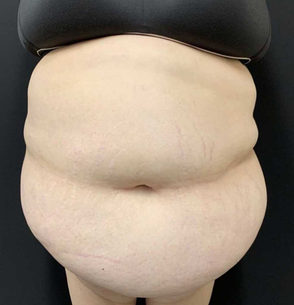 Tummy Tuck Before & After