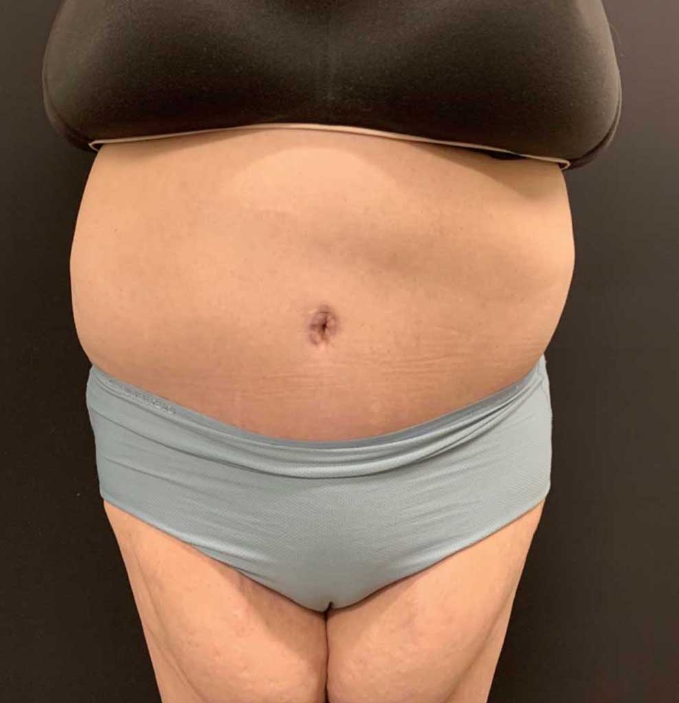 Tummy Tuck Before & After