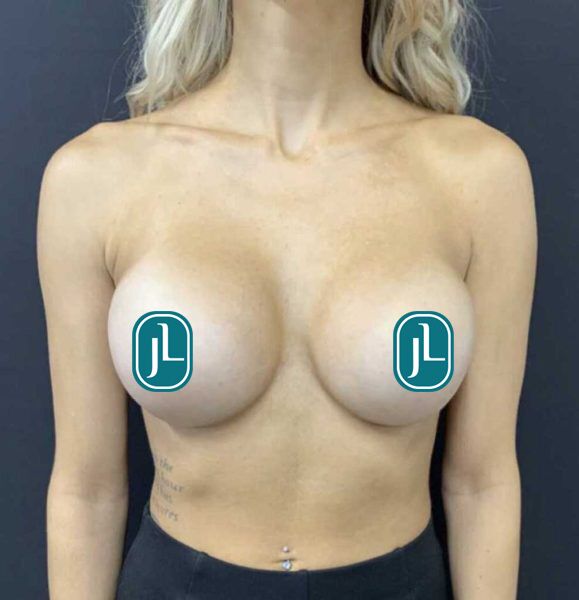 Breast Aug_After