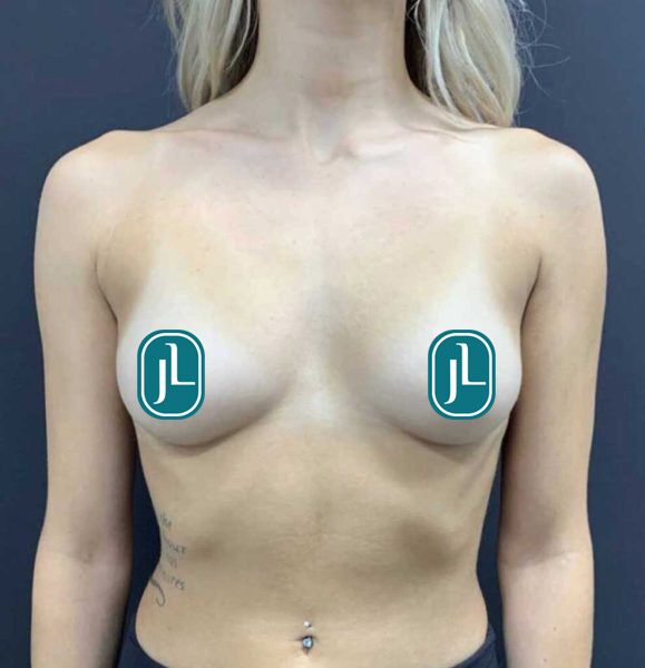 Breast Aug_Before