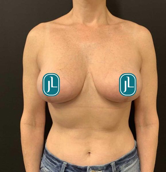 breastlift_After