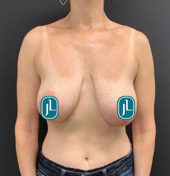 breastlift_Before
